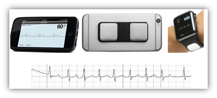 alivecor