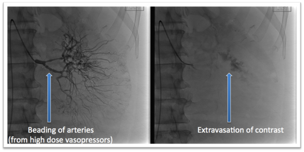 Angiogram