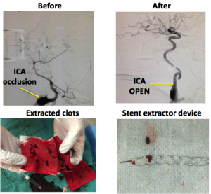Before and after clot exraction