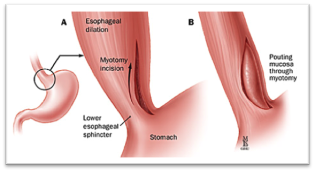 Laparoscopic