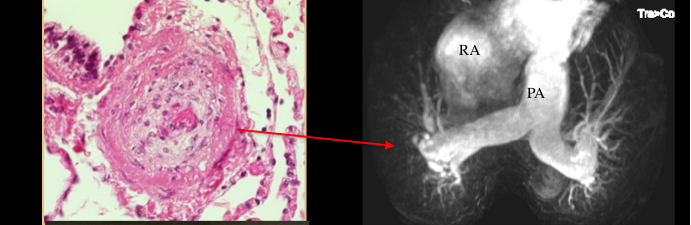 lung-blood-vessels-pah