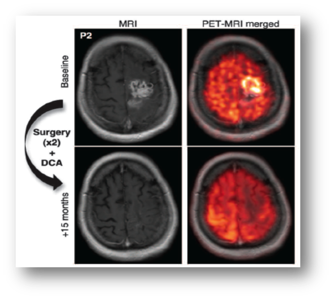 MRI PET