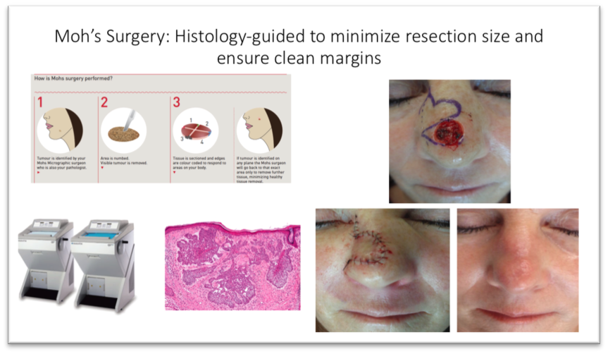 mohs-surgery-graphic