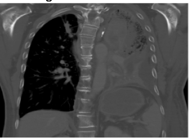 non-small-cell-lung-cancer