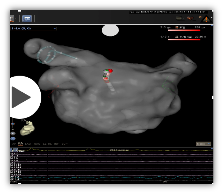 pacemaker