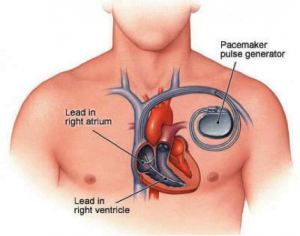 Placement of pacemaker diagram