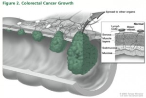 Preventing colon cancer: it’s not that hard a pill to swallow