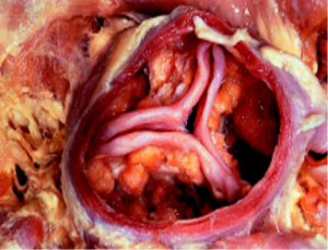 TAVI fig 2