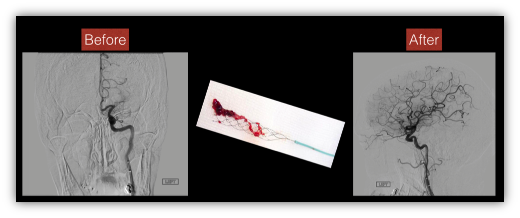 thrombolysis