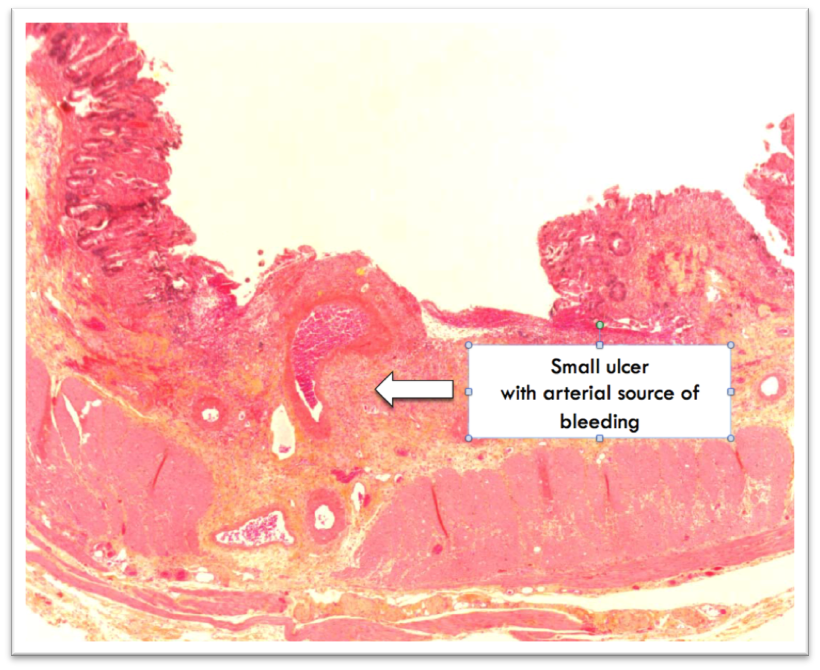 Can bloodsucking parasitic hookworms be the secret weapon against coeliac  disease and type 2 diabetes?