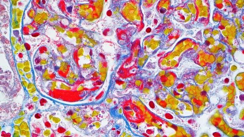 
                         Histology                                                    - 
                          Martius Scarlet Blue of Plancenta.  A trichrome stain for fibrin and connective tissue                                                    