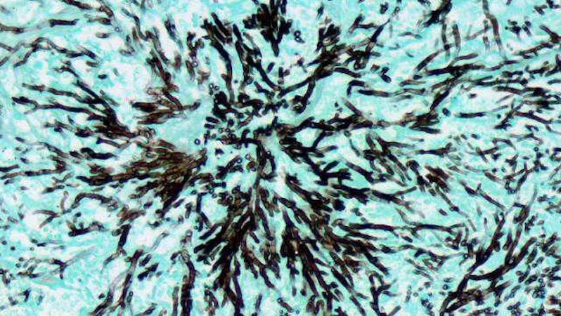 
                         Histology                                                    - 
                          Grogott's Methenamine Silver stain of fungi in lung tissue                                                    