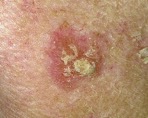 skin cancer image