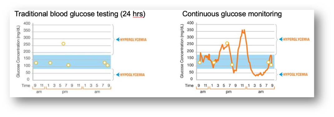 Continuous glucose monitoring - the third revolution in diabetes care ...