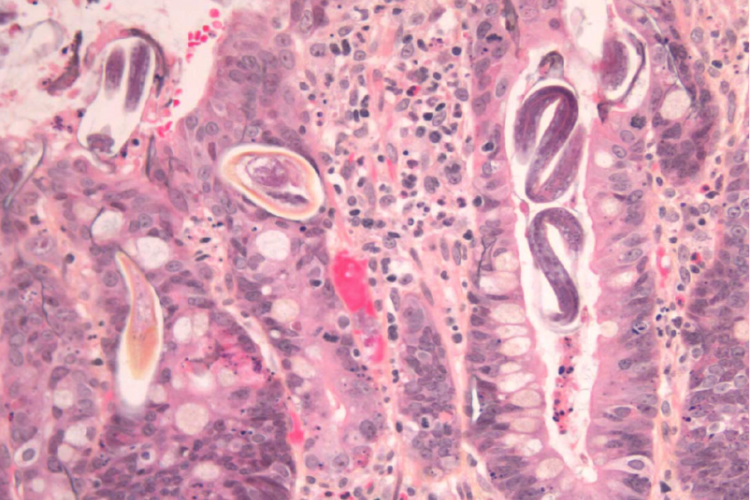 The Case of the Invisible Worm: The Immigrant’s Nemesis