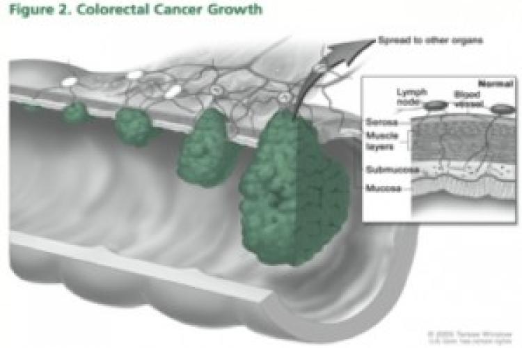 Preventing colon cancer: it’s not that hard a pill to swallow