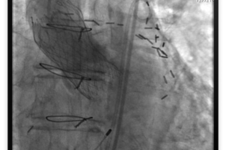 Replacing the Aortic Valve Without Surgery: Queen’s and KGH Enter the Fray