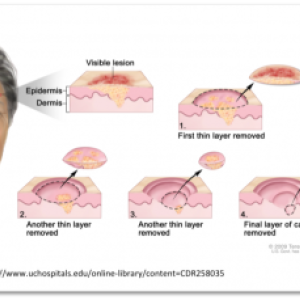 Skin in the Game: Research, Education and Mohs Surgery-Queen’s has it all