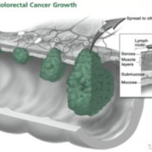 Preventing colon cancer: it’s not that hard a pill to swallow