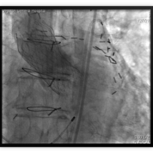 Replacing the Aortic Valve Without Surgery: Queen’s and KGH Enter the Fray